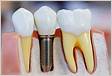 Preço de implante dentário 1 dente